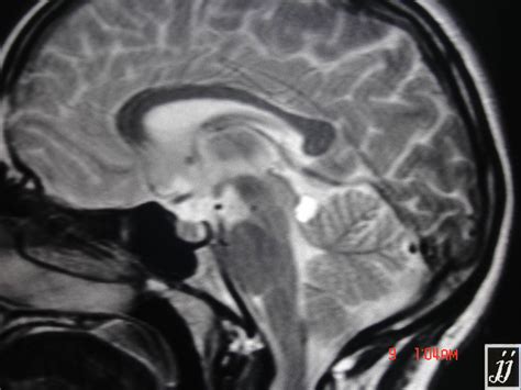 Lipoma On Quadrigeminal Cistern Radiopaedia