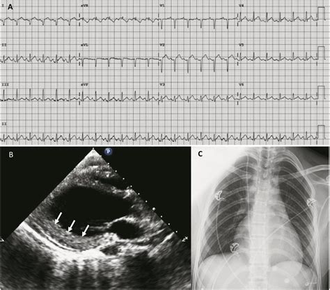 Electrocardiogram EKG Transthoracic Echocardiogram TTE And Chest