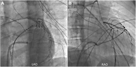 Fluoroscopic Views During Coronary Angiography A Left Anterior