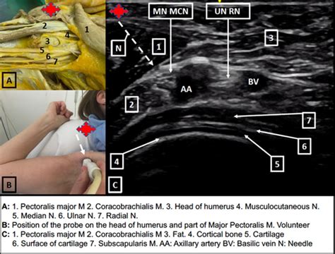 Axillary Nerve Block