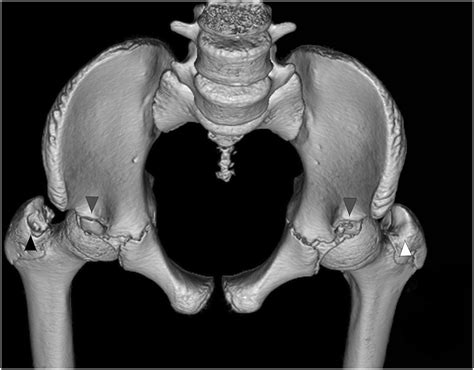 Apophyseal Avulsion Fracture Of The Conjoint Tendon Of Obturator