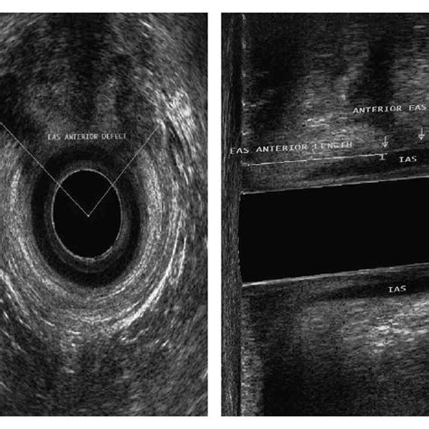 Pdf Is Digital Rectal Exam Reliable In Grading Anal Sphincter Defects