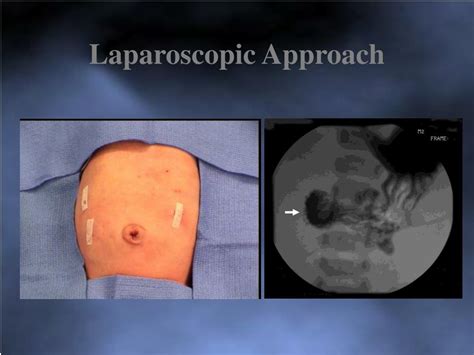 Ppt Laparoscopic Management Of Small Intestinal Atresia Powerpoint