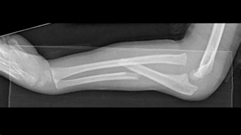 Monteggia Fracture Dislocations