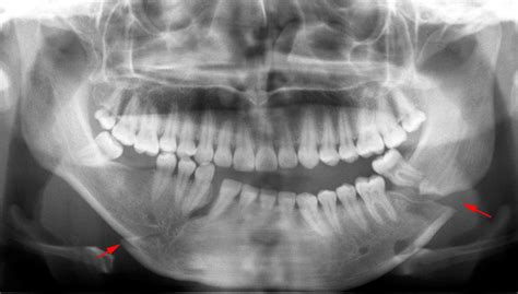 Caso 265 FRACTURA MANDIBULAR CDI