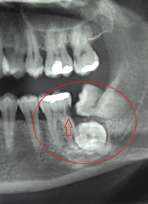 Denti Del Giudizio Quando Toglierli E Quando Tenerli Dentista Resta