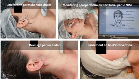 Chirurgie Des Glandes Salivaires Dr Chhuor Chirurgien ORL Nantes