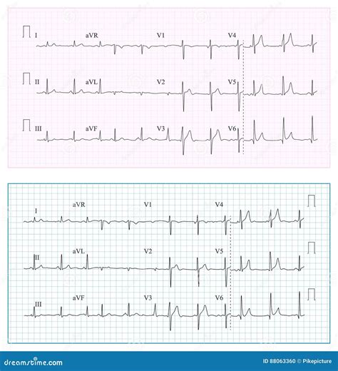 Cardiac Ischemia. Symptoms, Treatment. Icons Set. Vector Signs