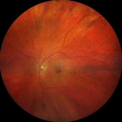 Optometry Atlas Macular Diseases Viewpoint