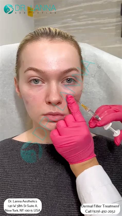 Can Cheek Fillers Make Your Nose Look Smaller? | Doctor Lanna