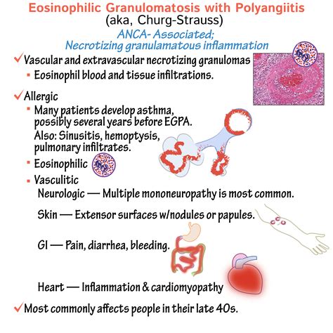 Pathology Glossary: Eosinophilic granulomatosis with polyangiitis (aka ...