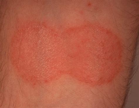 Mycosis Fungoides Pictures Staging Symptoms Treatment And Causes