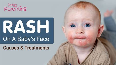 Red Spots On Baby Face Cheap Sale