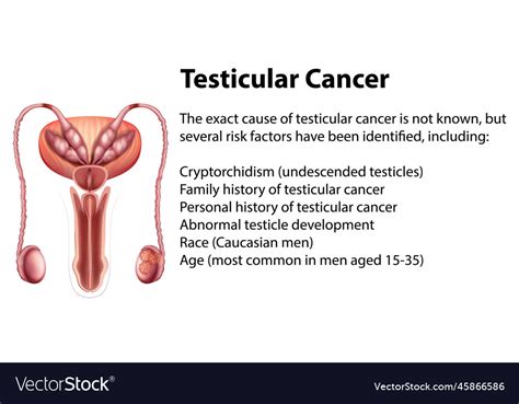 Testicular Cancer Removal at Jeffery Rizer blog