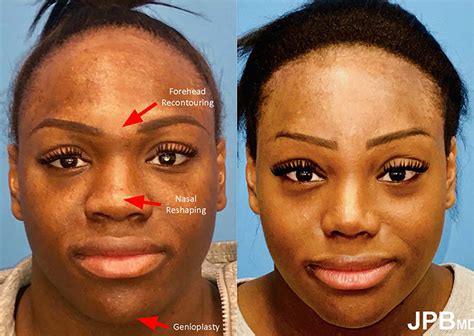 Facial Feminization Surgery New York City Ffs Great Neck