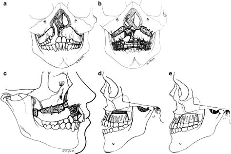 Lefort I Osteotomy Pocket Dentistry