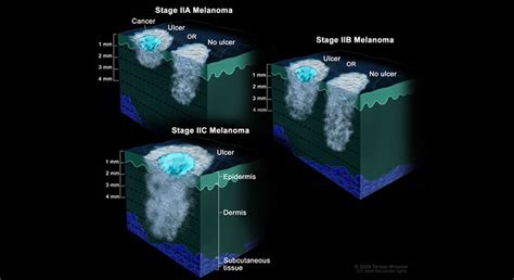 The 5 Stages of Nail Melanoma - Upsmash