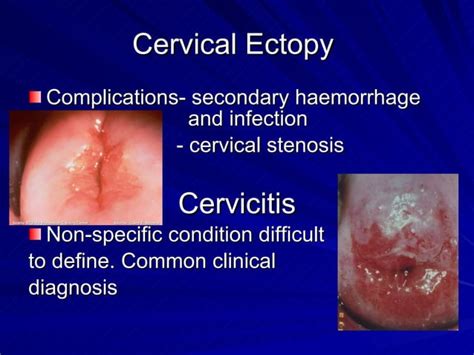 Benign Lesions Of The Cervix Vagina And Vulva Ppt Sexual Conditions Sexual Health