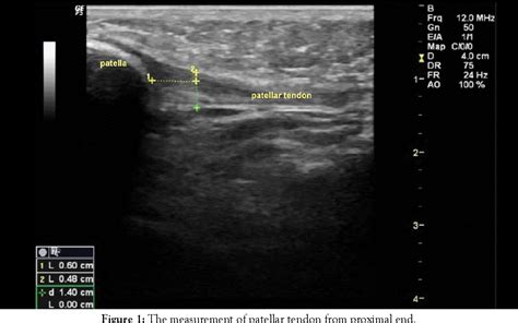 Figure From Concordance Of Patellar Tendinopathy In Patients With