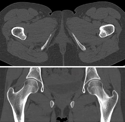 Pelvic Bone Anatomy Axial Human Anatomy