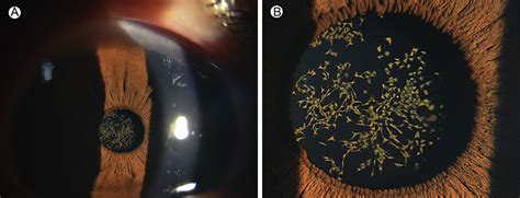 Epicapsular Stars Ophthalmology