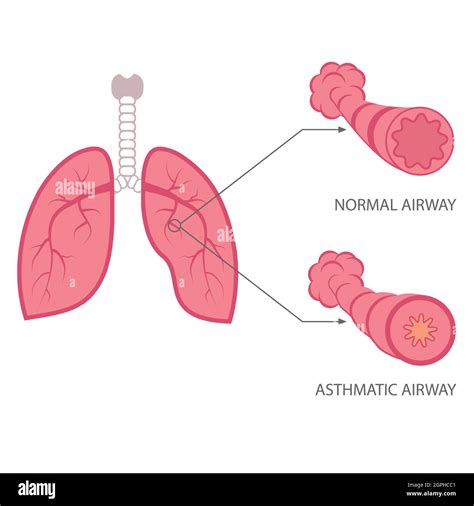 The Anatomy Of An Asthma Attack Stock Vector Images Alamy