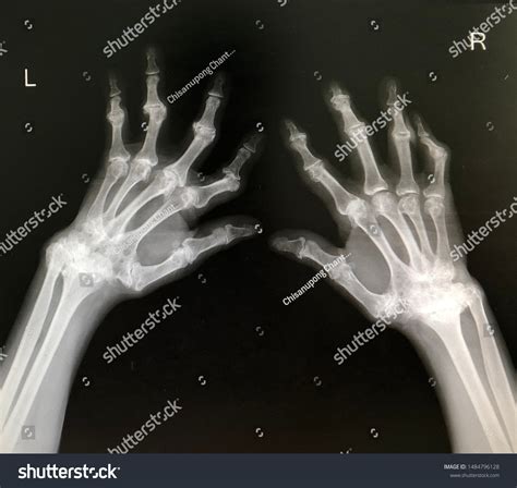 906 Rheumatoid Arthritis Xray Images, Stock Photos & Vectors | Shutterstock