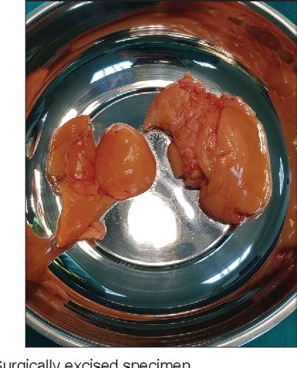 Figure 4 From A Giant Groin Lipoma Mimicking An Inguinal Hernia A Case