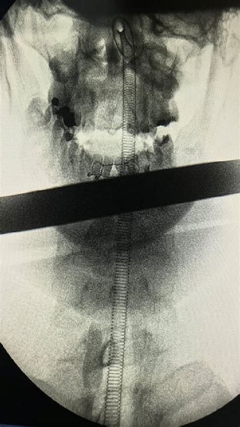 Fluoroscopic Image Of The Chest Region Showing Dental Element