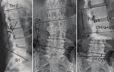 Diagram Showing The Measurement Of Lumbar Lordosis Ll A Coronal