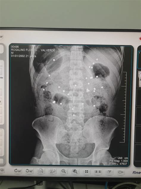 El Tórax Y Abdomen Son Las áreas Más Impactadas Por Paf En 50 Peruanos