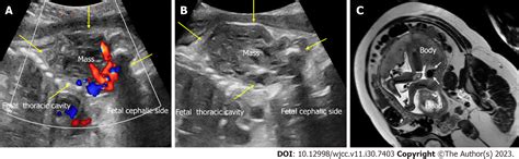 Infantile Hemangioma Ultrasound