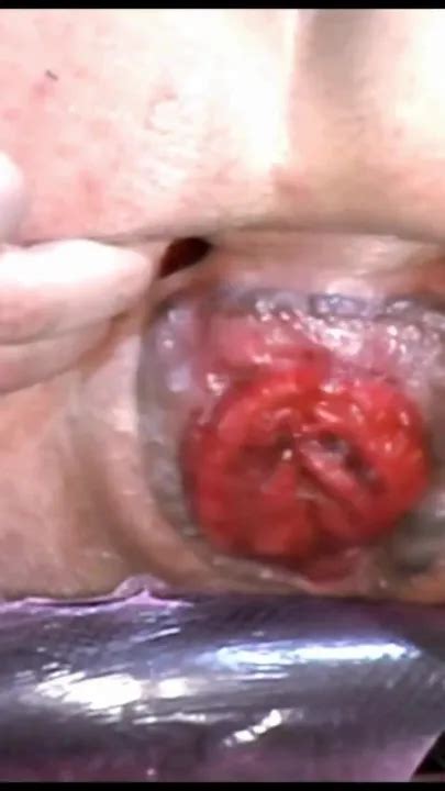 Huge Anal Prolapse Pumping Shemale BDSM BDSM Porn Feat Anita Cocks By Beacons XHamster