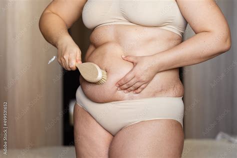 Cropped Overweight Woman In Underwear With Naked Excessive Weight And Visceral Fat Abdomen