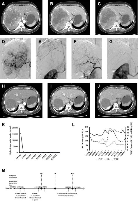 Figure 1 From Modified Hepatic Arterial Infusion Chemotherapy Combined