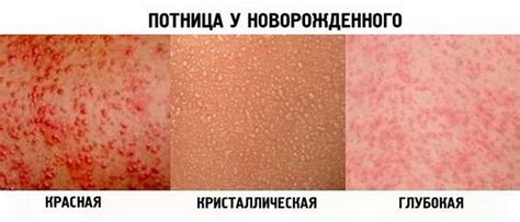 Потница у взрослых: лечение, причины, симптомы, растворы и мази ...