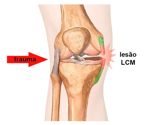 Lesão do Ligamento Colateral Medial do Joelho Especialista em Joelho