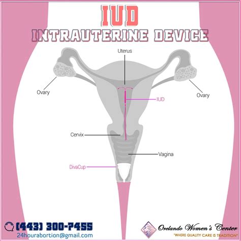 Copper Iud And Period Cup at Pablo Joyce blog