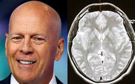 Qué es la demencia frontotemporal Enfermedad que padece Bruce Willis