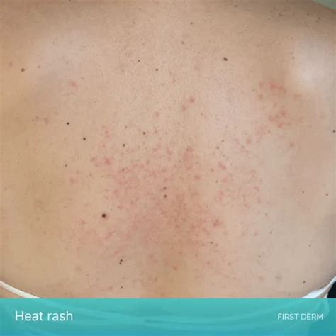 Top 27 Photos Photos Of Sweat Rash Under Breast Superb