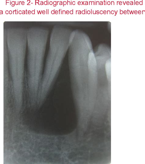 Figure 2 From A CASE REPORT OF KERATOCYST ODONTOGENIC TUMOR MIMICKING A