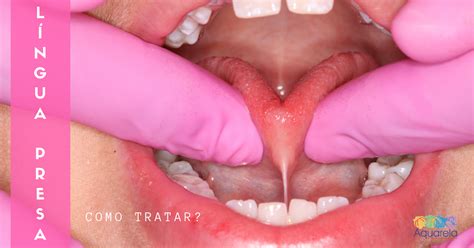Língua presa, como tratar? - Aquarela Odontologia Brasília