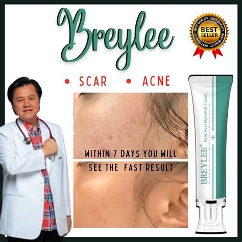 ORIGINAL Breylee Acne Scar Removal Cream Lazada PH