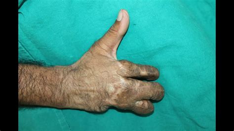 Groin Flap For Hand Reconstruction Youtube