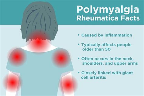 What Is Polymyalgia Rheumatica These Are The Signs You Could Have It