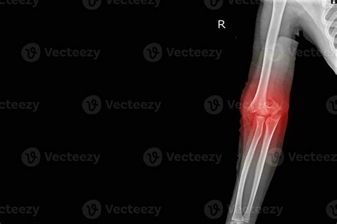 X Ray Elbow Joint Finding Supracondylar Fracture Distal Humerus With