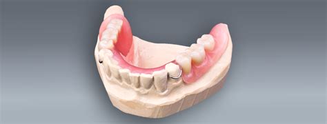 acrylic-partial-dentures - South Calgary Denture and Implant Clinic