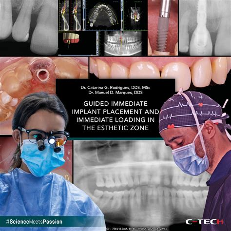 Cementation In Dental Implantology An Evidence Based Guide 10