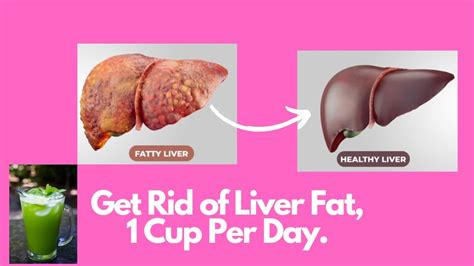 How To Treat Fatty Liver Dr Eric Drink One Cup A Dayloseweight Youtube