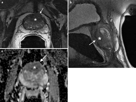 Prostate Cancer Imaging Radiology Key